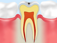 C0【ごく初期の虫歯】