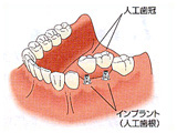 インプラント